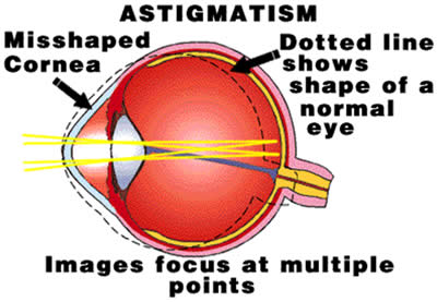 astigmatism