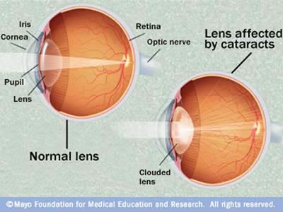 Cataracts - Sheppard Opticians